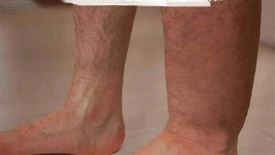 ما هي أضرار احتباس السوائل في الجسم ؟ وكيفية الوقاية منه ؟
