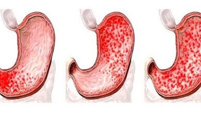 أعراض الته0اب المعدة وأسبابه وعلاجه وطرق الوقاية منه