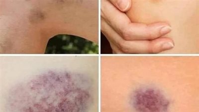 أعراض تدل على وجود جل0طات بجسمك