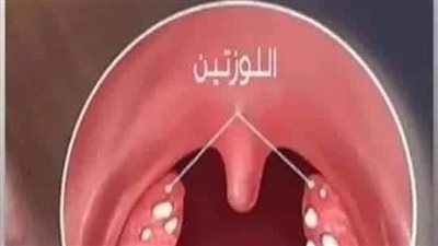انسي التهاب اللوزتين وداعاً لجراحة اللوز وشكاوي الاطفال والكبار اليك وصفة منزلية للقضاء عليها