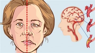 أعراض السكتة الدماغية 7 علامات احذر تجاهلها