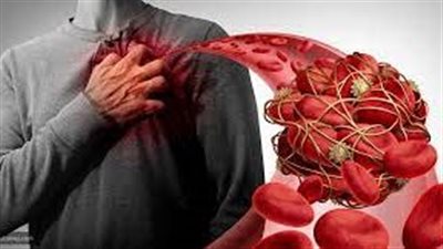 علاج انسداد الشرايين بمجموعة نصائح وطرق منزلية