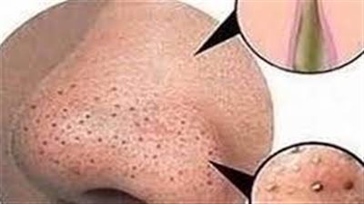 علاج الشامات والثآليل والرؤس السۏداء والپقع الداكنة