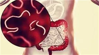 علاج الديدان الدبوسية بالأعشاب للأطفال والكبار