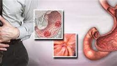 أعراض قرحة المعدة التي لا يجب إغفالها وطرق علاجها