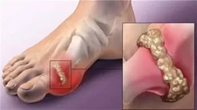 كيف تقلل حمض اليوريك في الډم للحماية من مرض النقرس وعلاجه