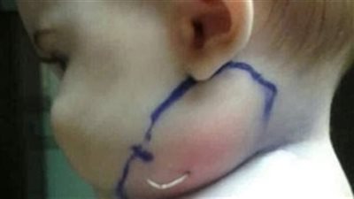 اعتقدت الأم أنها مجرد بثرة لكن عندما فتح الطبيب وسحبها صدم الجميع بما رأوه وحذروا جميع الأمهات