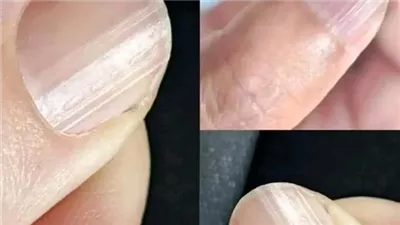 وجود أظافر مخططة قد يعني أن جسمك