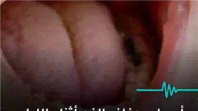 جفاف الفم أثناء الليل من المشكلات الذي يعاني منها الكثير لماذا يحدث وكيف يمكن التعامل معه؟